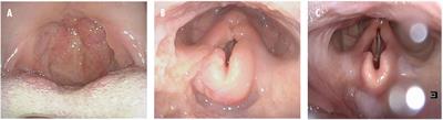 Case Report: Hyper IgM Syndrome Identified by Whole Genome Sequencing in a Young Syrian Man Presenting With Atypical, Severe and Recurrent Mucosal Leishmaniasis